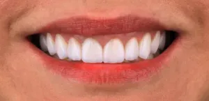 Depois - Dentes Amarelados